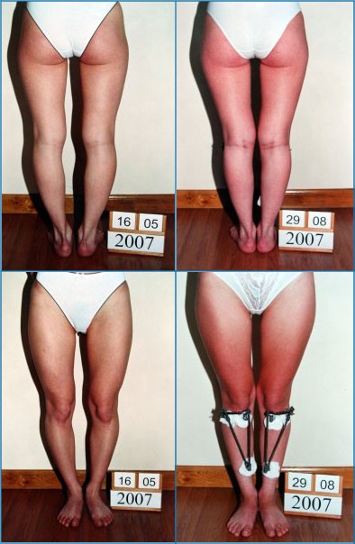 Кривые Ноги У Девушек Фото Как Исправить