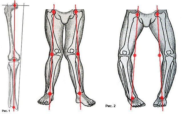 Деформирующий артроз коленных суставов и кривые ноги
