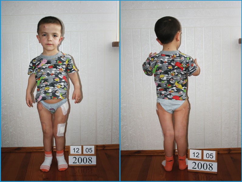 Ребенок 3 года не растет. Аппарат Илизарова ахондроплазия. Короткие конечности у ребенка. Одна нога короче другой у ребенка.