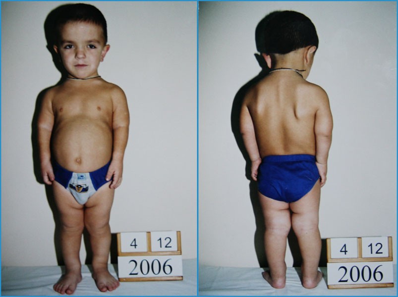 Ребенок 3 года не растет. Дисплазия карликовость танатофорная. Хондродистрофия, рахит. Ахондроплазия карликовость. Ахондропластическая карликовость генетика.