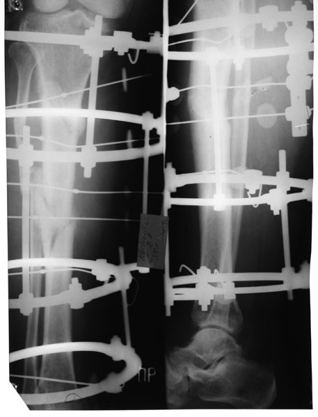 Перелом н 3. Аппарат Илизарова рентген. Остеосинтез голени аппаратом Илизарова рентген. Остеосинтез аппаратом Илизарова рентген. Остеосинтез большеберцовой кости аппарат Илизарова.
